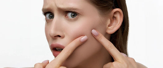 Acne: What You Can and Can't Do About It