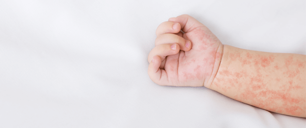 Atopic dermatitis: causes and treatment