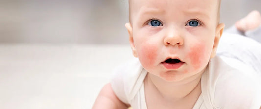 Atopic dermatitis: how to recognize and treat it