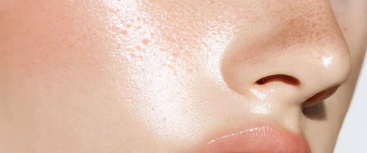 Post-acne: How to get rid of the condition and remove acne marks